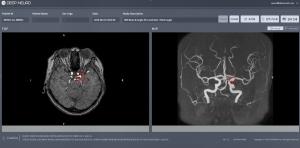 딥노이드, 뇌동맥류 검출 AI 소프트웨어 ‘딥뉴로’ 의료기기 허가 획득